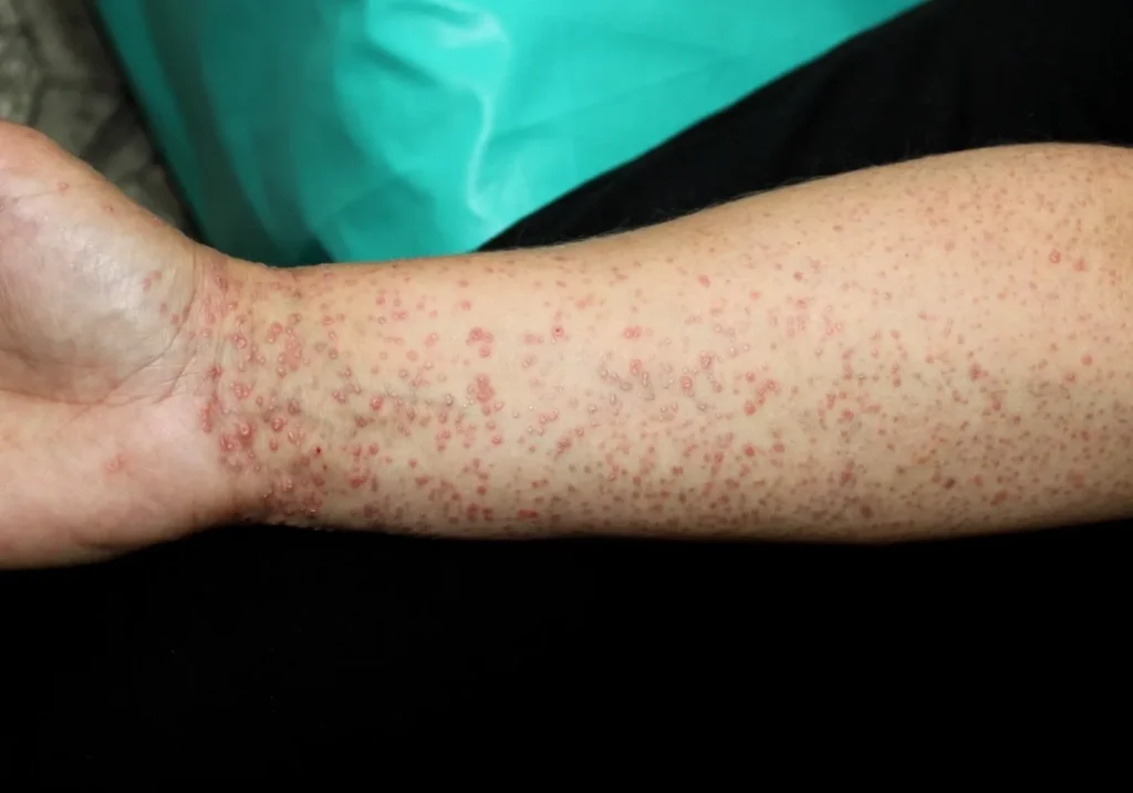 Lichen Planus – Inflammatory Skin Condition