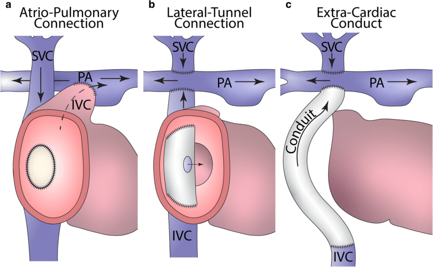 Unveiling the Power of the Lateral Tunnel Fontan Procedure