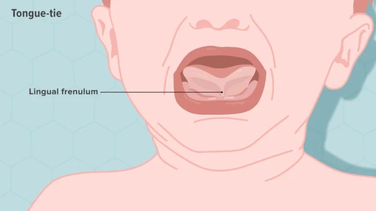 Tongue-Tie Newborn