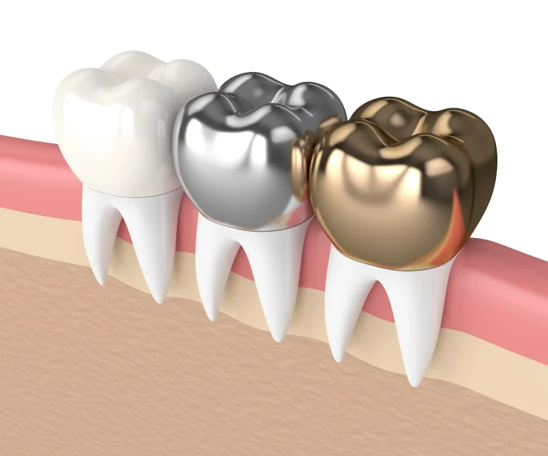 What Are Silver teeth in Kids