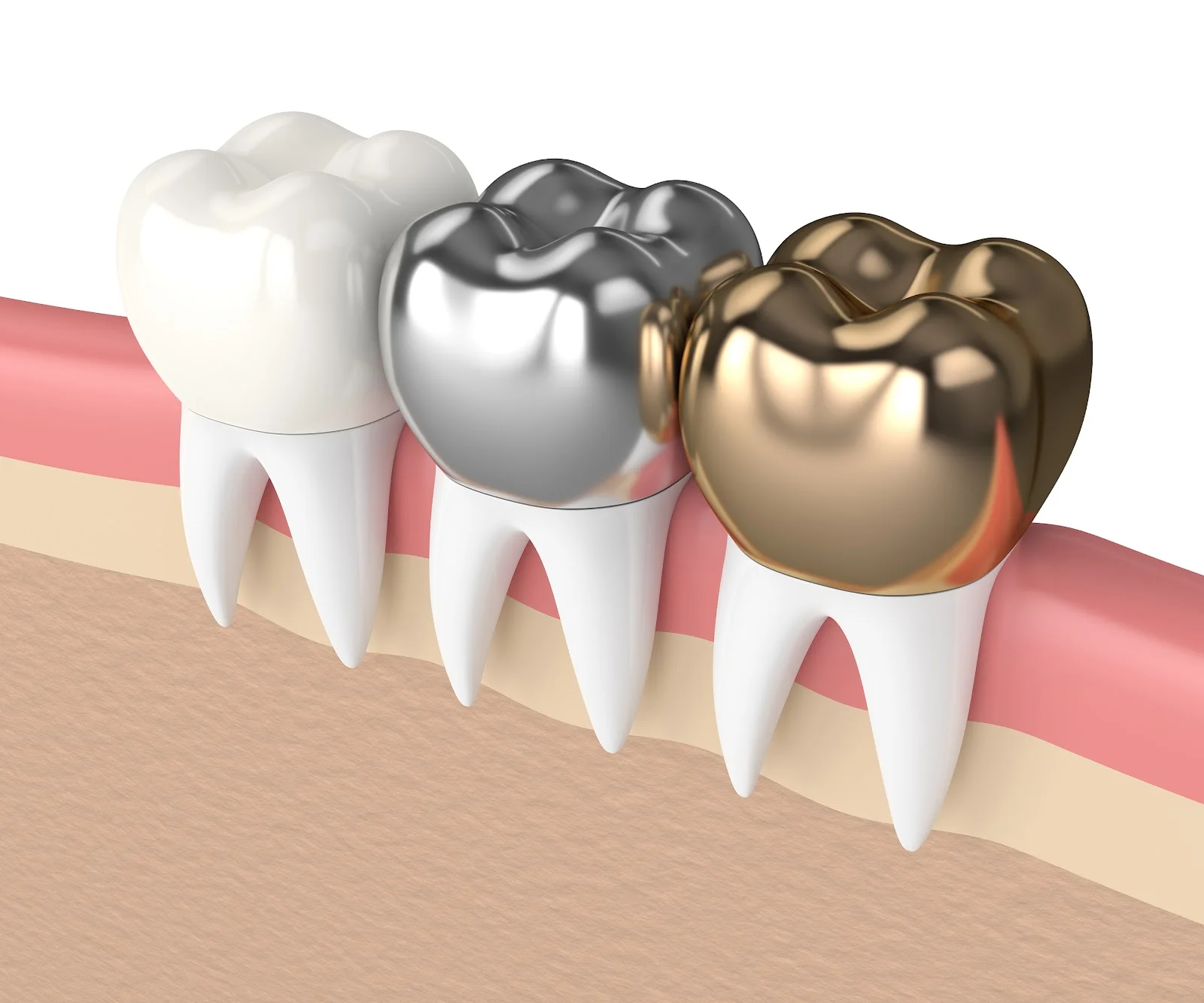 What Are Silver teeth in Kids